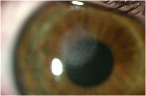 Corneal Ulcers Phoenix Eye Doctors