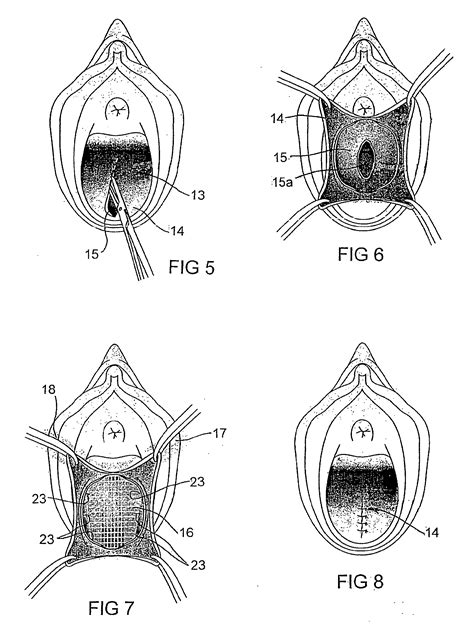 Patent Ep A Method Of Surgical Repair Of Vagina Damaged By Pelvic Organ Prolapse And