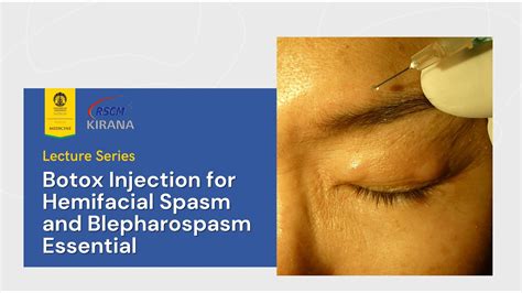 Neuro Ophthalmology Lecture Botox Injection For Hemifacial Spasm And