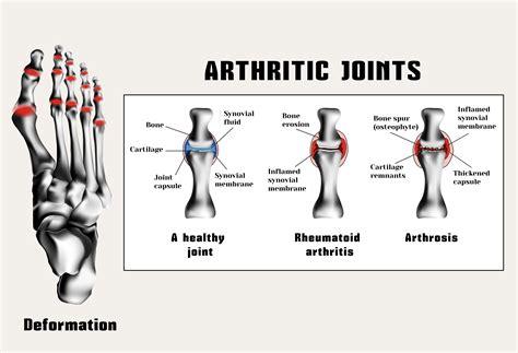 Arthritis Of Foot And Ankle Pain Treatment Advanced Foot And Ankle