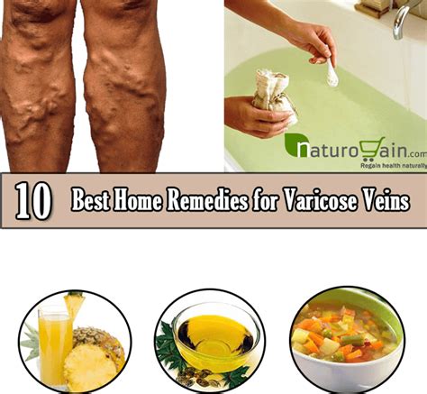 10 Safe And Best Home Remedies For Varicose Veins