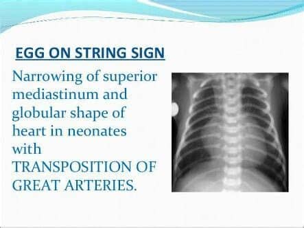 The primary arteries (the aorta and the pulmonary artery) are transposed. TGA ...1),egg in side appearance | Arteries, Neonatal ...