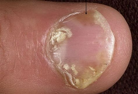Top 10 Most Common Nail Diseases And Disorders Promed Clinic