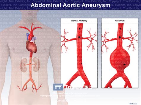 Abdominal Aortic Aneurysm Trialexhibits Inc
