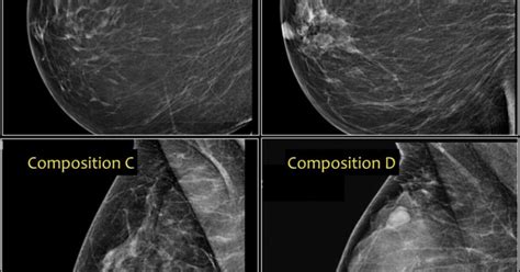 What Mammogram Images Tell Us About Breast Cancer Risk