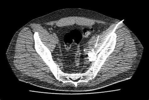 CT Guided Percutaneous Abscess Drainage Contrast Material Has Spread