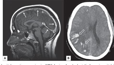 They may lead to bleeding into the surrounding brain tissues. Figure 1 from How to treat cerebral venous and sinus ...