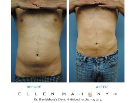 Liposuction For Obese Men