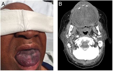 Angioedema In A Patient With Neuroendocrine Tumour Bmj Case Reports