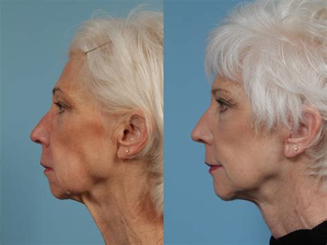 Chin Lift Surgery Hot Sex Picture