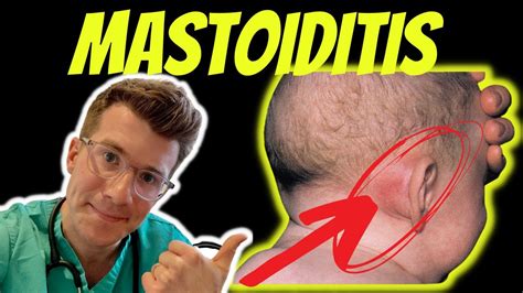 Doctor Odonovan Explains Mastoiditis Including Anatomy Symptoms