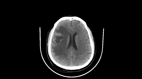 Brain Metastasis Ct Scan Bild Kaufen 13623265 Science Photo Library