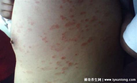 玫瑰糠疹图片初期症状，和梅毒皮疹难区分治疗时不能烫水洗澡 — 神奇养生网