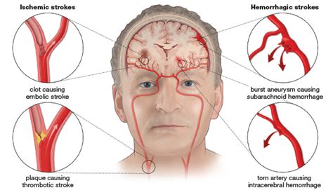 The hock laboratory explores the molecular basis of blood cell formation and the pathogenesis of leukemia and lymphoma. Dr. Sng Kim Hock - Neurologist (brain physician) | Teleme ...