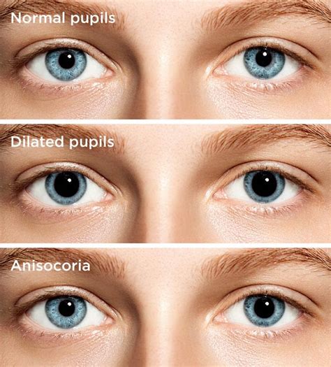 Wat Veroorzaakt Verwijde Pupillen Verwijde Ogen Bril Op Je Hoofd