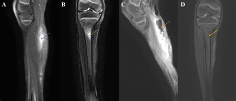 Mri Findings Of The Right Lower Extremity A Sagittal View Of The Right