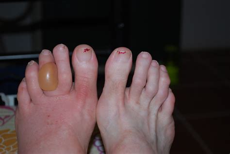 Bug Bite On Foot Pictures Photos