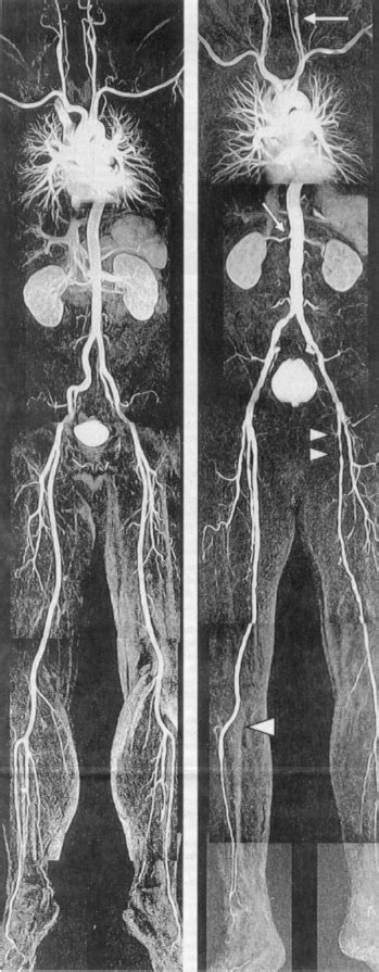 Angiography Of The Whole Body Performed By Clinical Magnetic Resonance