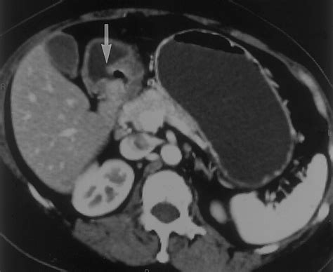 Current Role Of Ct In Imaging Of The Stomach Radiographics