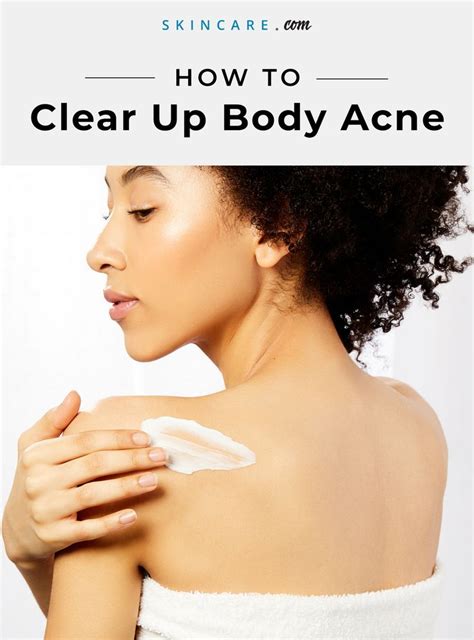 Body Acne 101 How To Get Rid Of Chest And Back Acne Acne Acnetips