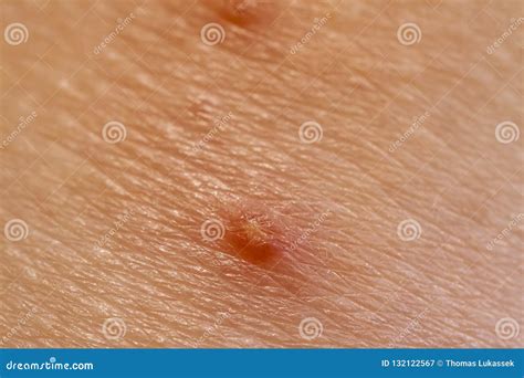 Close Up Of Molluscum Contagiosum Also Called Water Wart Stock Image