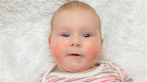 الامراض الجلدية عند الاطفال الأكثر شيوعاً وعلاجها صحة الطفل فورنونو