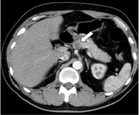 Axial Post Contrast Ct Finding Showed A Small About 12 Cm Size Low