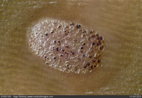 Stock Image Dermatology Plantar Wart Verruca A Warty Skin Lesion