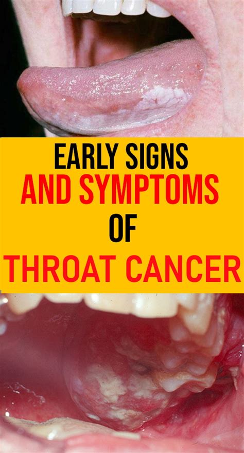 Throat Cancer Early Signs Symptoms Causes And Prognosis Healthy Lifestyle