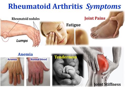 Arthritis 7 Most Painful Types Of Arthritis Cause Symptoms Treatments