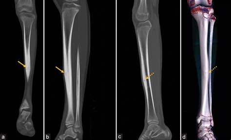 Stress Fracture X Ray Tibia
