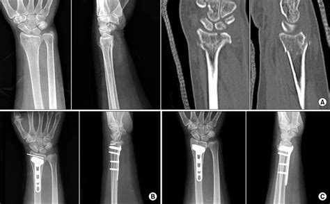 A 62 Year Old Woman With An Ao Type B33 Partial Intra Articular Distal