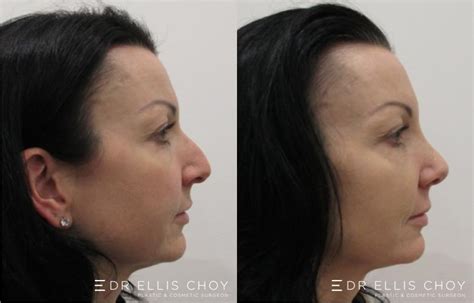 Surgical Nose Reshaping Before And After