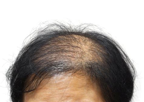 Hair Loss Twin Cities Dermatology Center