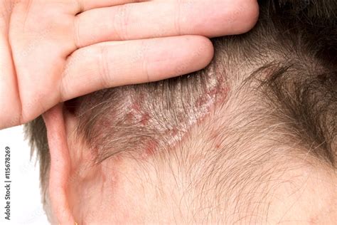 Psoriasis Psoriatic Skin Disease Foto De Stock Adobe Stock