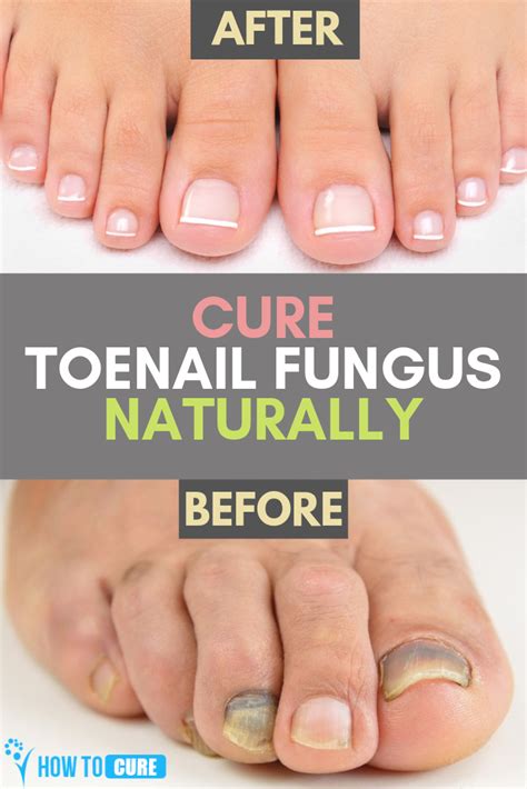 How To Get Rid Of Thick Toenails With Top 5 Home Remedies Thick