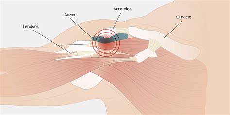 Shoulder impingement is a progressive orthopedic condition that occurs as a result of altered biomechanics and/or structural abnormalities. Shoulder Impingement - The Complete Injury Guide - 2018 ...