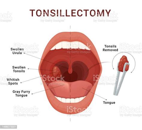 Tonsillectomy Scheme Removal Of Palatine Tonsils Acute Pharyngitis