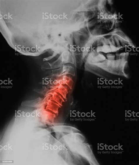 Xray Image Of Cervical Spine Lateral View Stock Photo Istock
