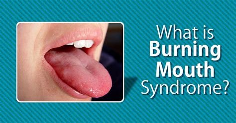 Burning Mouth Syndrome Is A Painful Complex Condition And Often