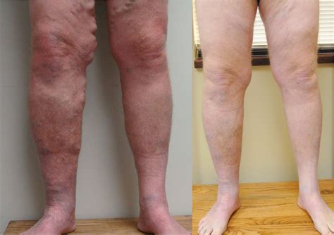 Before And After Photos Vein Specialists Of The Carolinas