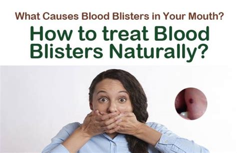 15 Easy Home Remedies To Get Rid Of Blood Blisters In The Mouth