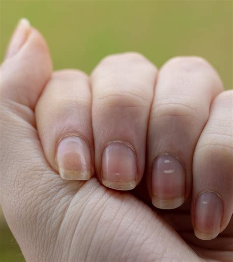 White Spots On Nails Recon Hospitallity