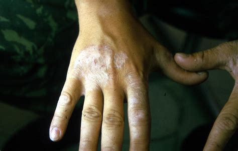 Superficial Fungal Infections Tinea Multiple Lesions Picture