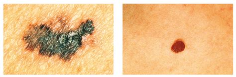 Early Stage Melanoma Symptoms Doctor Heck