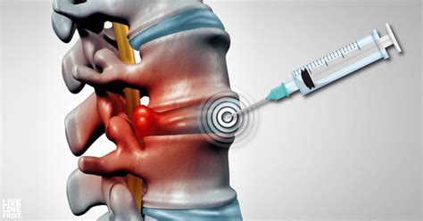 Fda Warns About Dangers Of Epidural Steroid Injections For Back Pain
