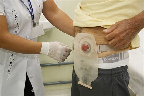 Vivir con una ostomía Programa SPICA