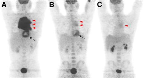 Prognostic Value Of Interim 18f Fdg Pet In Patients With Diffuse Large