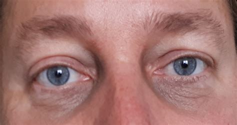 Iron Deficiency Anemia Eyes