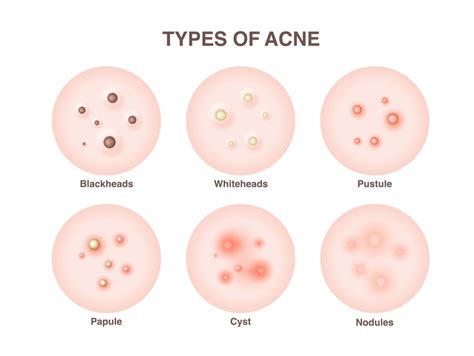 Understanding The Six Types Of Acne And How To Treat Them